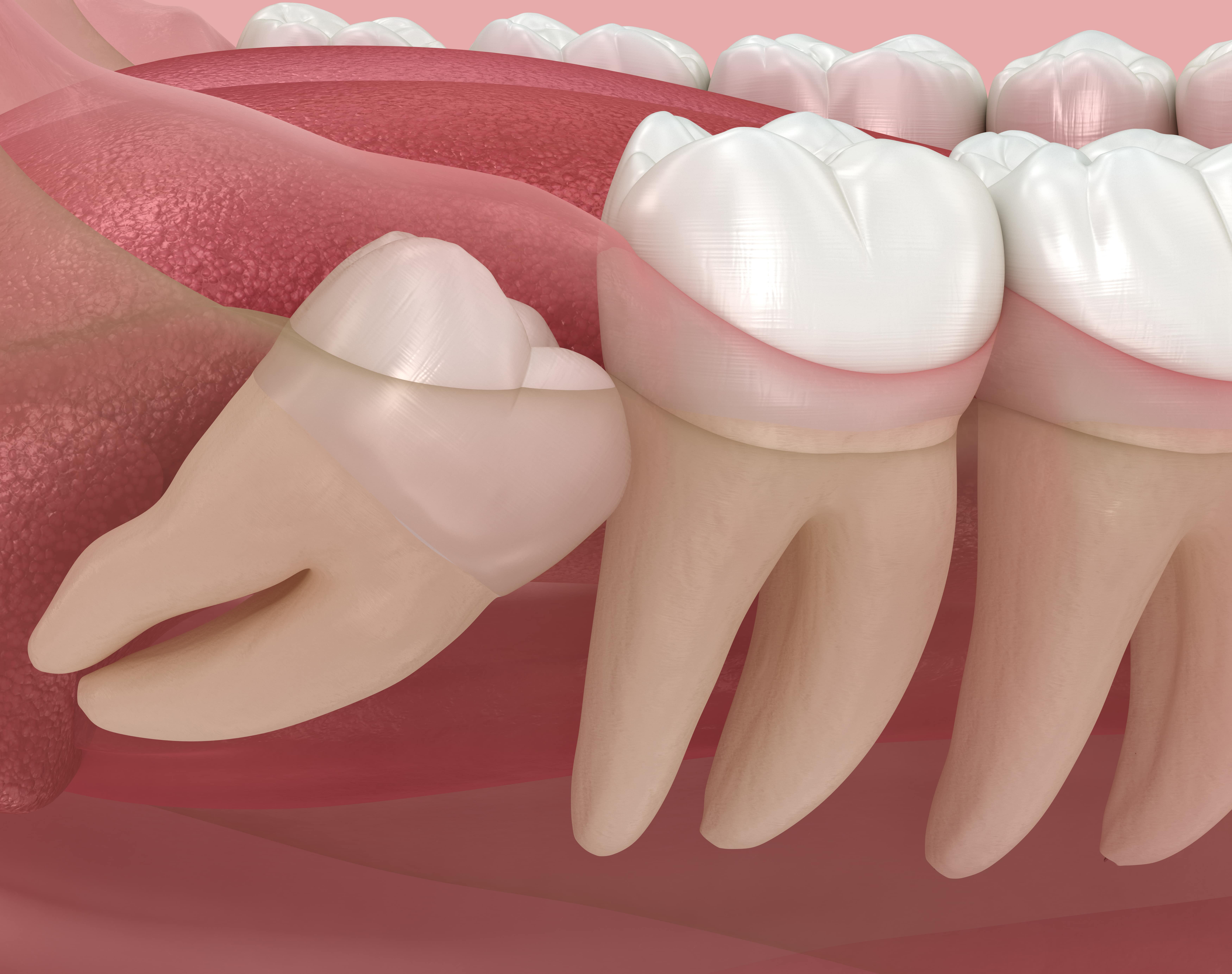 Wisdom Teeth Removal